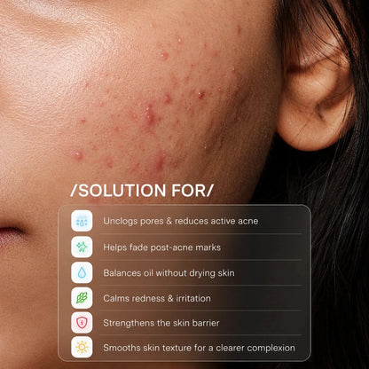 ACNE FIX - Anti Acne Serum